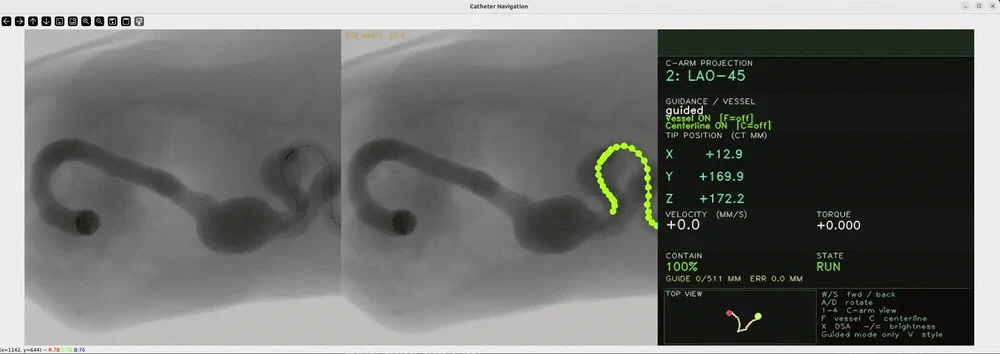 Simulated fluoroscopy with catheter navigation guidance.