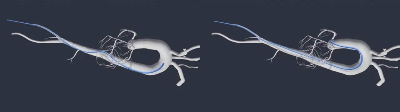 Two catheter paths through simulation vasculature.